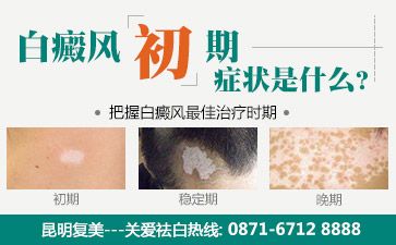 昆明治疗白斑病去那家医院